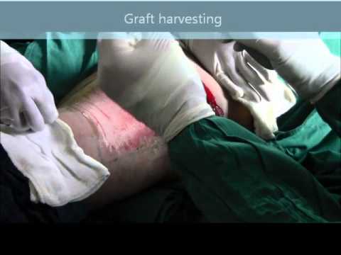 how to harvest skin graft