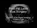 Post-RK Lasik Eye Surgery (short version) Post-RK Lasik Eye Surgery (short version)