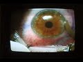 Post-RK Lasik Eye Surgery (short version)