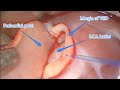 Aortic Valve Repair, Aortic Valve Prolapse, VSD Repair Aortic Valve Repair, Aortic Valve Prolapse, VSD Repair