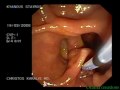 ERCP STONES KARALIS 139DVD.mpg