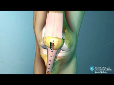 how to rebuild knee ligaments