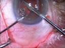 This is an IOL decentered within the capsular bag due to fibrosis of the capsular bag and adhesions displacing the lens.  Cataract surgery was done 7 years earlier.  Note the use of a Lasik Canula as a dissecting tool to reopen the capsular bag.