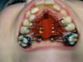 Braces part 2