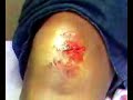 Self Suture Self Suture