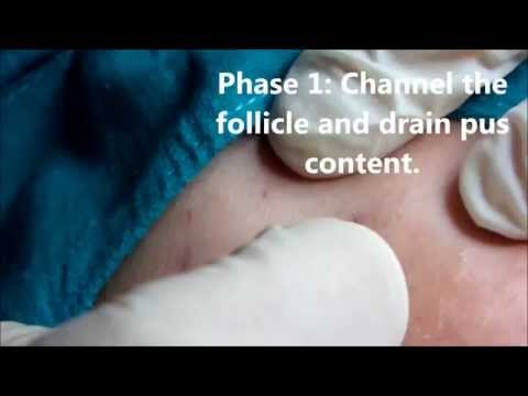 how to treat nodules