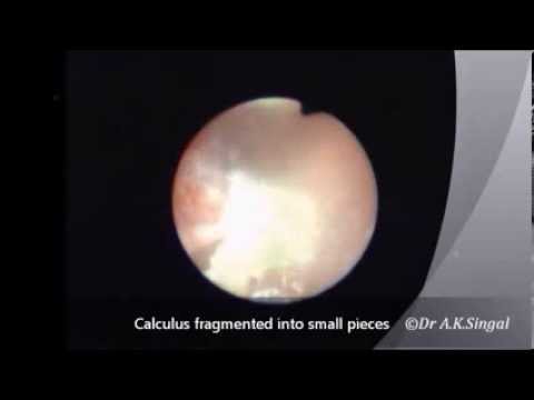 how to treat 9mm kidney stone