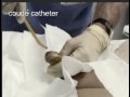 Male-Urethral-Cathet