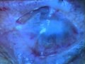 Blind Woman Sees Again Thanks to a Tooth NBC Washington