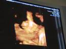 Baby Stickland Ultrasound 7-13-07