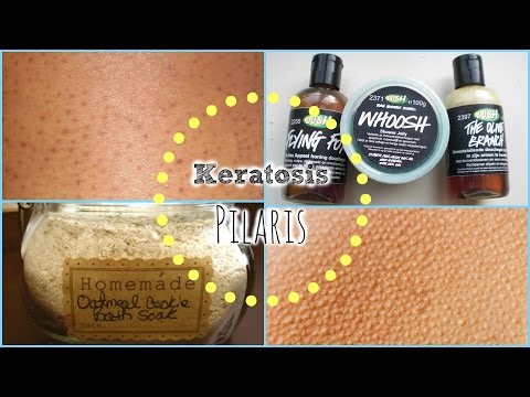 how to treat keratosis pilaris