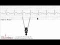 ECG Interpretation Basic Level - Part 5 ECG Interpretation Basic Level - Part 5