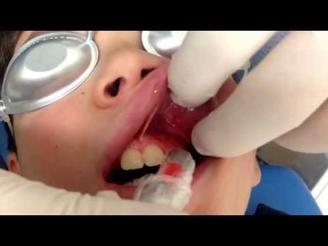how to treat aftas