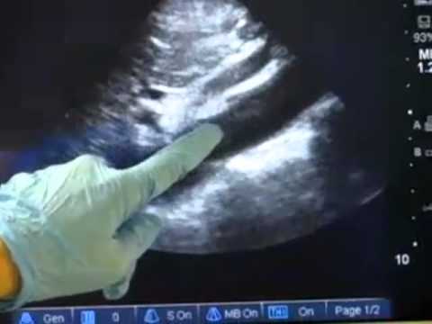 how to perform aortic ultrasound