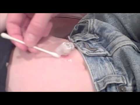 how to care for g tube site