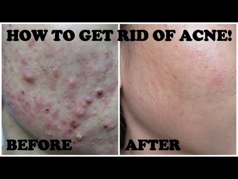 how to get rid asian flush