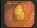 Intestinal Feature & Life-Style Related Diseases Part 1 Intestinal Feature & Life-Style Related Diseases Part 1