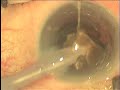 Mature Cataract Tortion Phaco (My 2nd Case)