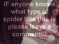 Really Bad Spider Bite