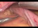 Gastric Sleeve or Sleeve Gastrectomy