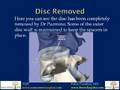 TLIF, Transforaminal Lumbar Interbody Fusion by Pablo Pazmino MD