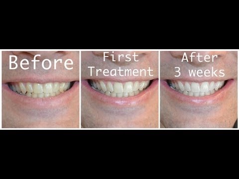 how to whiten your teeth with hydrogen peroxide