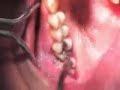 Please visit us at www.leadershipindentistry.com for innovative dental continuing educuation that combines dental CE with personal and leadership skills to ensure successful results.This video shows how to simplify an upper molar tooth extraction with the use of periotomes, and sectioning.  Socket preservation was also done to simplify future implant placement.