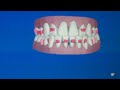 Invisalign Computerized 3D Image of Teeth