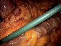 Revision, Mini-Gastric Bypass Revision, Mini-Gastric Bypass
