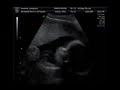 3D ultra sound, my baby at 25 Weeks