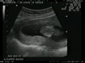 Echographie Oct. 2006