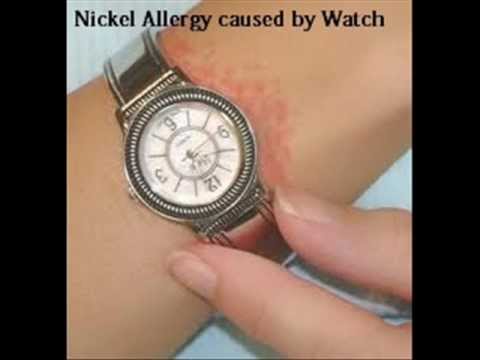 how to cure nickel allergy