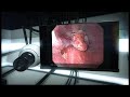 Esophageal Cancer