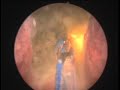 Prostatectom�a con l�ser HPS