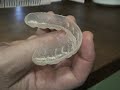 How to apply dental whitening bleach to your bleaching tray