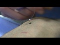 Japanese Acupuncture - Tonifying Rice Grain Moxibustion