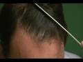 This is an example of an ultra-refined surgical hair restoration performed by Raymond Konior, MD The patient had 4200 grafts placed into the balding scalp regions. Multiple views demonstrate the naturalness of the procedure. The case history is presented at the following link: hair-restoration-info.com