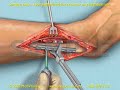3D/2D Medical Animation: Open Reduction and Internal Fixation (ORIF) of Fibula Fracture