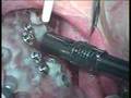 Teeth In An Hour with Zygomatic Dental Implants Pt.2 Guided Zygo