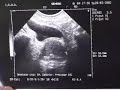 Prostatectomia con laser ktp -luz verde - prostata de 100 g Prostatectomia con laser ktp -luz verde - prostata de 100 g