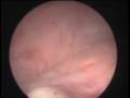 Prostatectomia con laser ktp -luz verde - prostata de 100 g