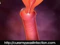 Cure Your Yeast Infection Permanently! Vaginal Yeast Infections