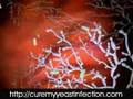 what causes a yeast infection, what causes yeast infection, what does a yeast infection look like,