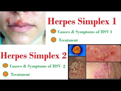 how to treat hsv 2