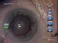 Gene Gullingsrud, MD Cataract Surgery