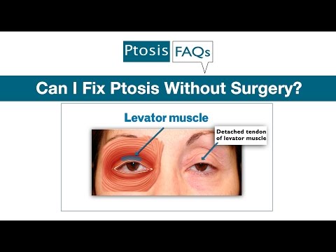 how to cure ptosis