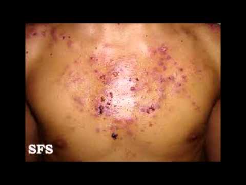how to get rid pus filled bumps