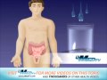 Colonoscopy Preparation - Golytely