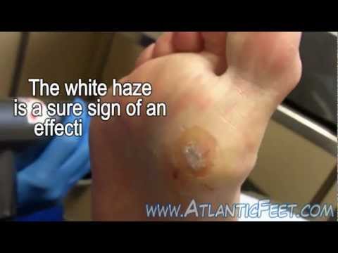 how to cure equine warts