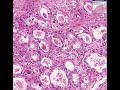 Histopathology Vagina--Clear cell carcinoma